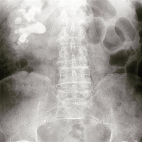 Staghorn Calculus In Patient With Recurrent Fevers Hematuria And Flank
