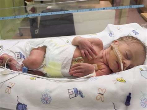 Moderate To Late Preemies Likely Go Home At 36 Weeks