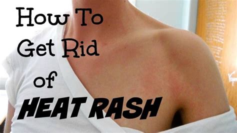 1000 Images About Heat Rash On Pinterest Skin Rash Allergies And Powder