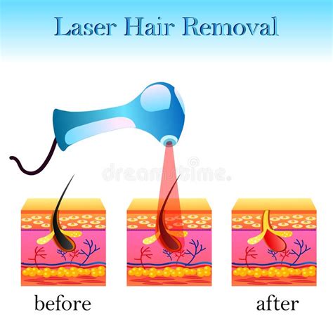 Laser Hair Removal Vector Diagram Stock Vector Illustration Of