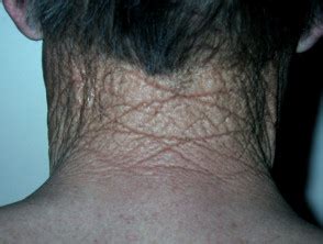 The comedones are widened openings for hair follicles and sebaceous glands filled with material. Solar comedo | DermNet NZ