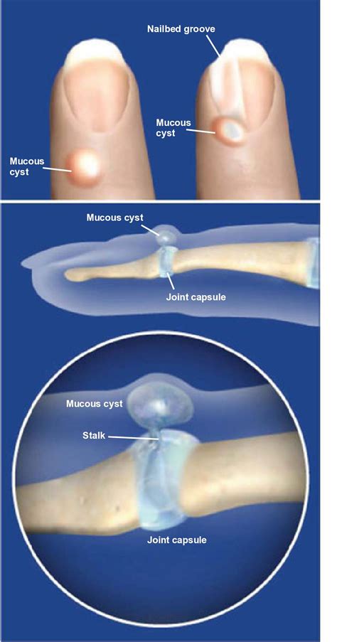 Causes Symptoms And Treatment Of Digital Mucous Cysts Orthopaedic