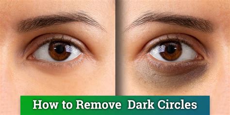Dark Circles Under Your Eyescauses And Treatment Western Pennsylvania Healthcare News