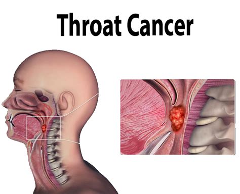 Throat Cancer Ultra Care Clinic