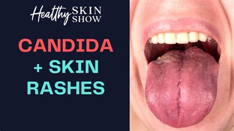 Candida And Skin Rashes A Hidden Root Cause Jennifer Fugo Youtube