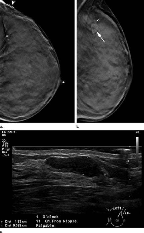 Images In A 41 Year Old Woman Evaluated With Diagnostic Dbt And Ffdm