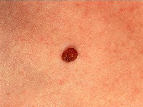 Identifying Moles Skin Cancer Or Mole How To Tell Cbs News