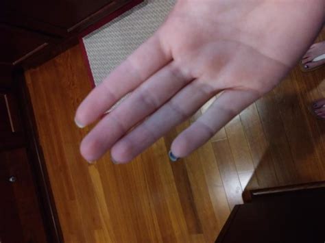 15 Photos That Show What It Looks Like To Live With Raynauds Syndrome