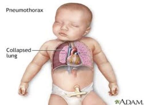 For example, there was a young boy who was in utero, and his mother noticed a couple weeks before his due date. NICU-PEDIA - Diagnosis and Conditions