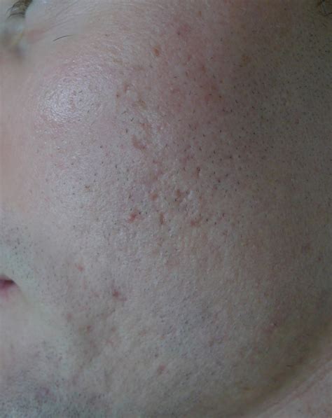 Acd A Z Of Skin Acne Scars Acne Scarring