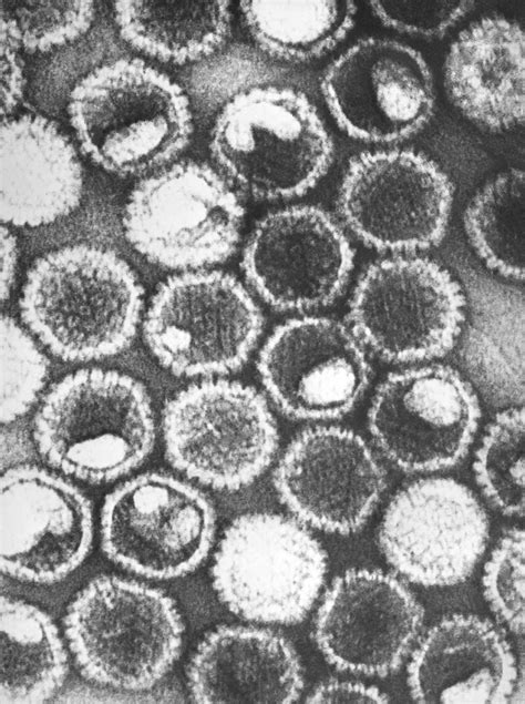 electron micrograph of herpes simplex virus biology of human world of viruses