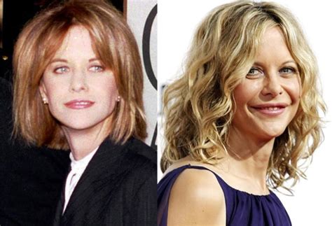 Meg Ryan Before And After Plastic Surgery 3 Celebrity Plastic