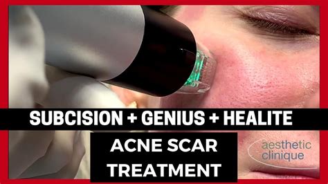 Rolling Acne Scars Treated With Cannula Subcision New Genius And