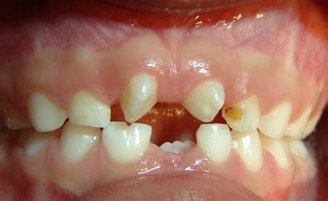 Ortodoncia En El Salvador Dientes Supernumerarios En Denticiòn Mixta