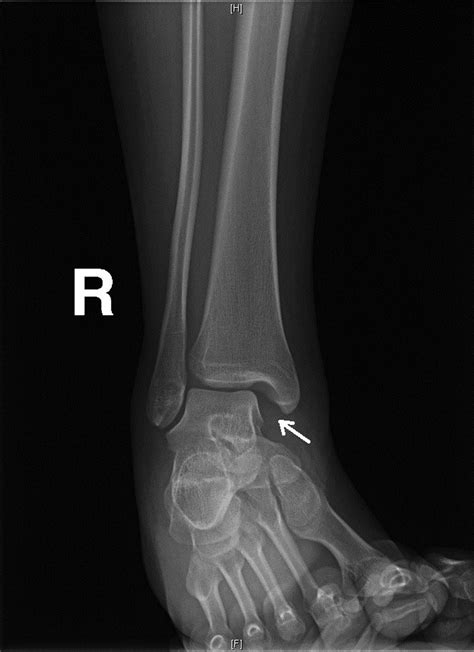 Unstable Ankle Injury With Normal Radiographs Journal Of Emergency