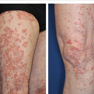 Gvhd Like Erythroderma Erythema Appeared On The Extremities And Body Trunk Download