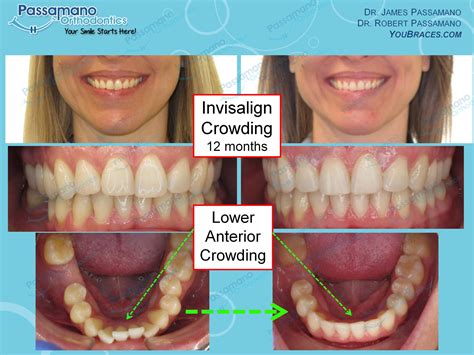 Braces And Invisalign Smile Gallery Passamano Orthodontics Irvine Ca