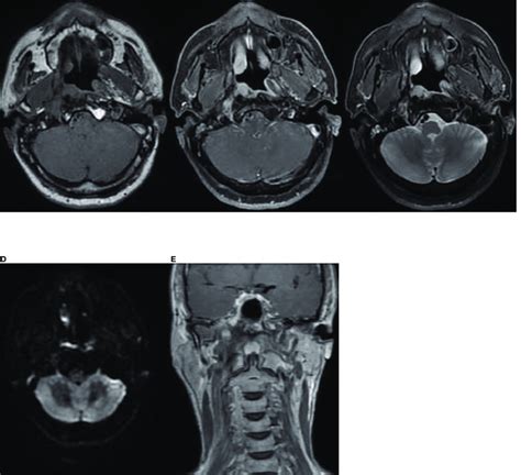 Nasopharynx And Neck Mri Findings From 10 January 2022 A D The Axial