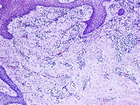 Pathology Outlines Hypertrophied Papillae