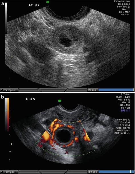 Ultrasound Evaluation Of The Uterus Radiology Key