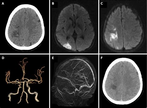 Hemorrhagic Transformation After Acute Ischemic Stroke Caused By