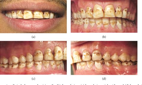 Figure 1 From Aesthetic Rehabilitation Of A Severe Dental Fluorosis