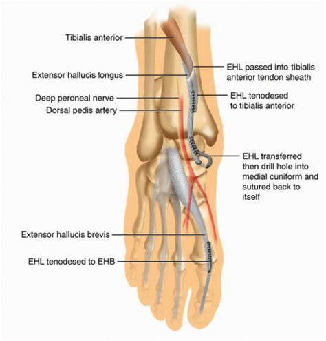 Reconstruction Of Tibialis Anterior Tendon Ruptures Musculoskeletal Key Sexiz Pix