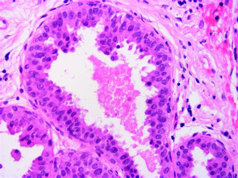 Non Operative Breast Pathology Columnar Cell Lesions Journal Of