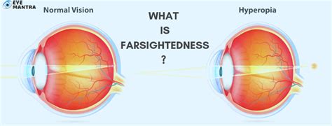 Farsightedness Hyperopia Symptoms Causes Andtreatment Eyemantra