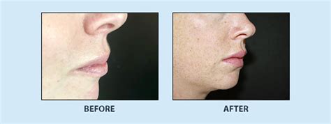 Permalip Before And After Dr Burt Greenberg Plastic Surgeon Located