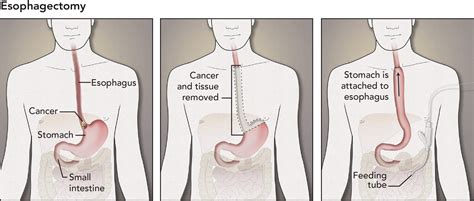 Evelyn Pence Esophagectomy