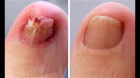 home remedy for toenail fungus coconut oil for nail fungus youtube