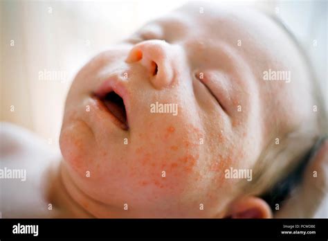 Neugeborenes Baby Junge Gesicht Mit Vielen Roten Pickel Von Atopischer