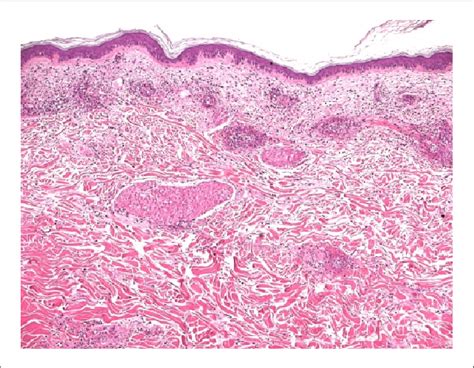 Figure Histology Of Leukocytoclastic Vasculitis Fragmented