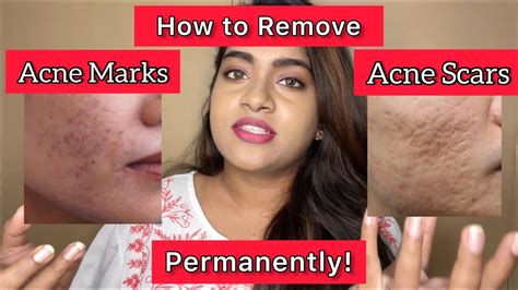 How To Remove Acne Marks And Acne Scars Permanently Youtube