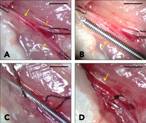 Wire Injury Procedure A The Common Femoral Artery Arrow The