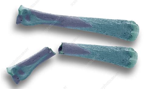 Osteoporotic Bones Sem Stock Image C0337096 Science Photo Library