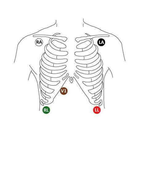 Holter Monitor 5 Lead Placement Diagram Hanenhuusholli