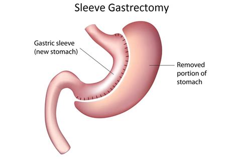 Gastric Sleeve Surgery General Surgery Gold Coast
