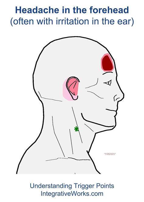 Understanding Trigger Points Headache In The Forehead Trigger