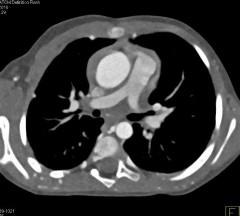 Coarctation Of The Aorta With Extensive Collaterals Vascular Case