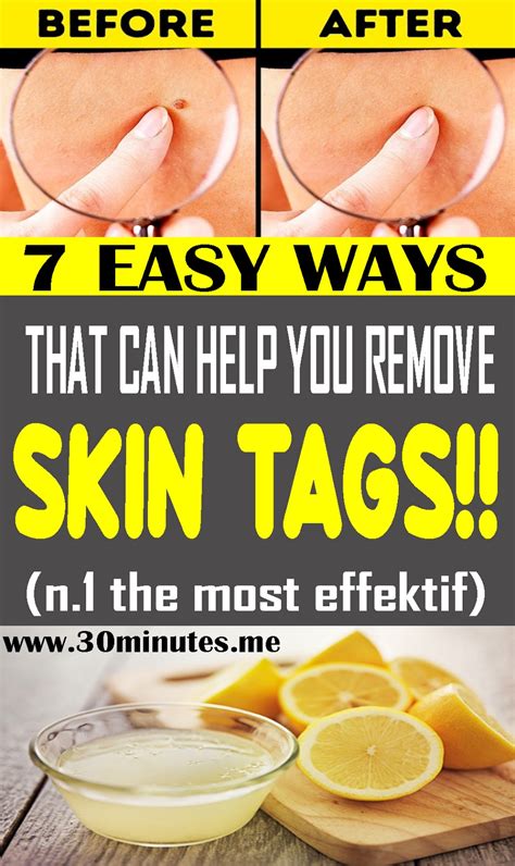 Here Are 7 Easy Ways That Can Help You Remove Skin Tags Health And
