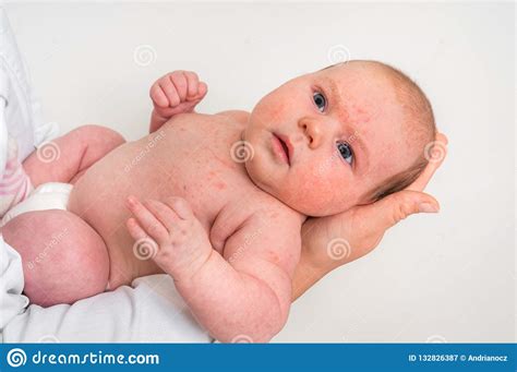 Newborn Baby With Skin Rash Allergic Reaction After Birth Stock Image