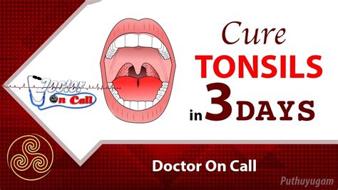 Quick Home Remedies For Tonsillitis In 3 Days Doctor On Call Youtube
