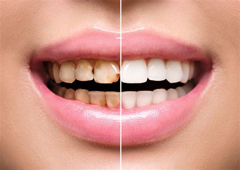 Prévenir l abcès dentaire Soins Bucco Dentaires Essentiels WebPhilo