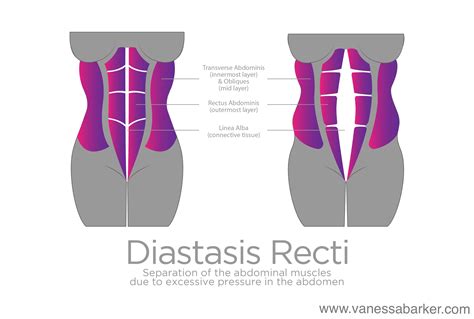 Diastasis Recti Vanessa Barker Fitness