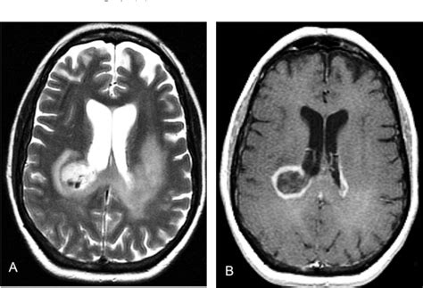 Figure 6 From Neuroimaging Of Tumefactive Multiple Sclerosis With