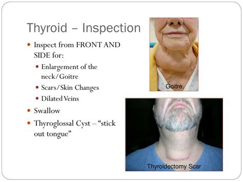 Ppt Thyroid Examination Revision Powerpoint Presentation Free