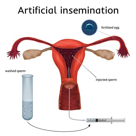 What To Expect With Intrauterine Insemination Iui Artofit