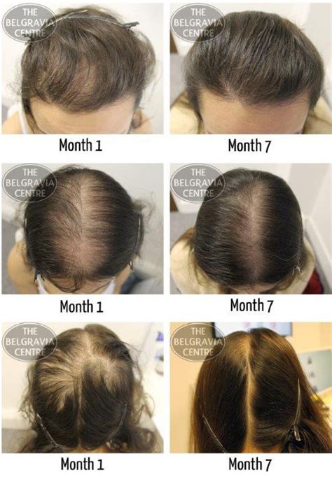 Women S Hair Loss Treatment Success Stories